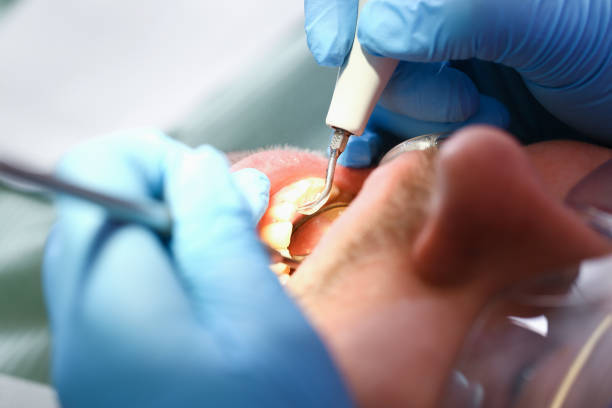 Best Emergency Root Canal Treatment in Poplar Plains, CT